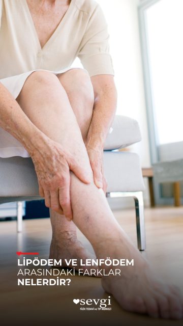 Lipödem mi, lenfödem mi? Aynı şey değiller.
Her ikisinde de bacaklarda şişlik görülebilse de tutulum şekli, eşlik eden belirtiler ve klinik bulgular birbirinden farklı olabilir.
Lipödem genellikle iki taraflı ve simetrik bir görünümle seyrederken, lenfödem tek taraflı da görülebilir ve ayak bölgesi de etkilenebilir.
🎥 Videoda lipödem ve lenfödem arasındaki temel farkları doktorumuz anlatıyor.
💬 Siz bu iki durumun farklı olduğunu biliyor muydunuz?
📌 Bu farkları daha sonra hatırlamak için videoyu kaydedin.
📲 Bacak şişliği yaşayan bir yakınınız varsa onunla paylaşabilirsiniz.
📍 Şikâyetlerin doğru değerlendirilmesi ve birbirinden ayırt edilmesi için uzman muayenesi önemlidir.
#Lipödem #Lenfödem #BacakŞişliği #FizikTedavi #LenfÖdem